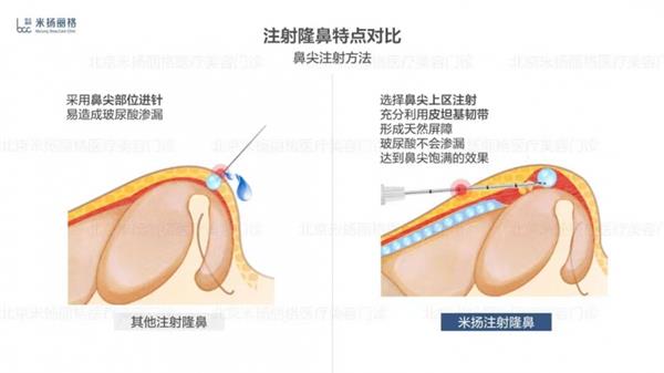 北京米扬丽格李振医生在鼻部注射和轮廓塑形方面的技术应用  第8张