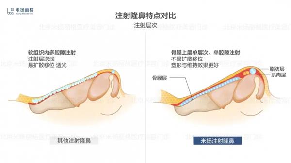 北京米扬丽格李振医生在鼻部注射和轮廓塑形方面的技术应用  第5张