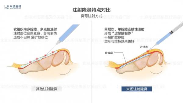 北京米扬丽格李振医生在鼻部注射和轮廓塑形方面的技术应用  第6张