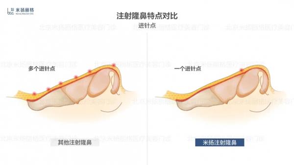 北京米扬丽格李振医生在鼻部注射和轮廓塑形方面的技术应用  第4张